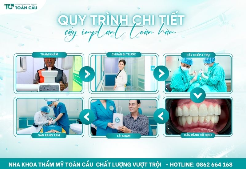 Nha khoa cấy implant toàn hàm uy tín tại TPHCM 9 Quy trình cấy implant toàn hàm tại Toàn Cầu