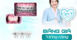Chi phí niềng răng mắc cài kim loại