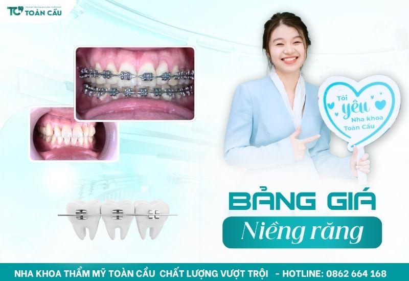 Chi phí niềng răng mắc cài kim loại