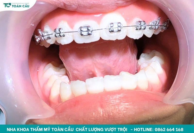 Chi phí niềng răng mắc cài kim loại bao nhiêu? Bảng giá mới nhất 5 Niềng răng mắc cài kim loại