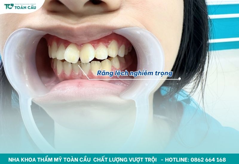 Chi phí niềng răng mắc cài kim loại bao nhiêu? Bảng giá mới nhất 7 Niềng răng mắc cài khắc phục khuyết điểm răng