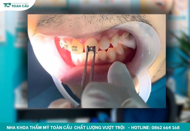 Chi phí niềng răng mắc cài kim loại bao nhiêu? Bảng giá mới nhất 8 Sử dụng mắc cài chính hãng chất lượng cao