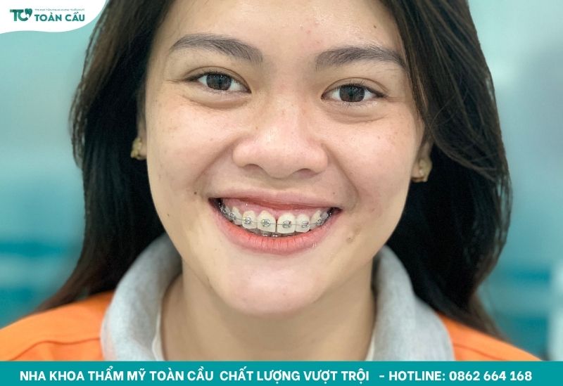 Chỉnh nha HCM mang lại nụ cười đẹp cho mọi lứa tuổi 7 Niềng răng mắc cài kim loại