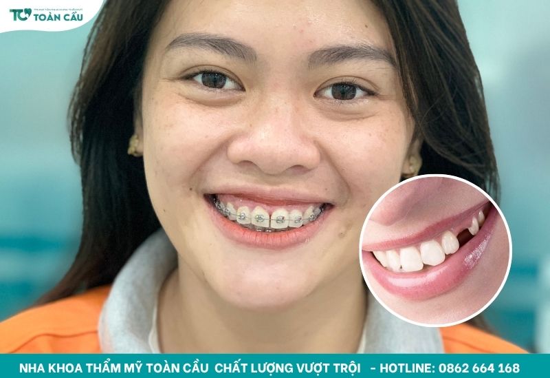 Giải đáp thắc mắc có nên nhổ răng số 4 để niềng không 5 Răng số 4 nằm ở vị trí khá quan trọng
