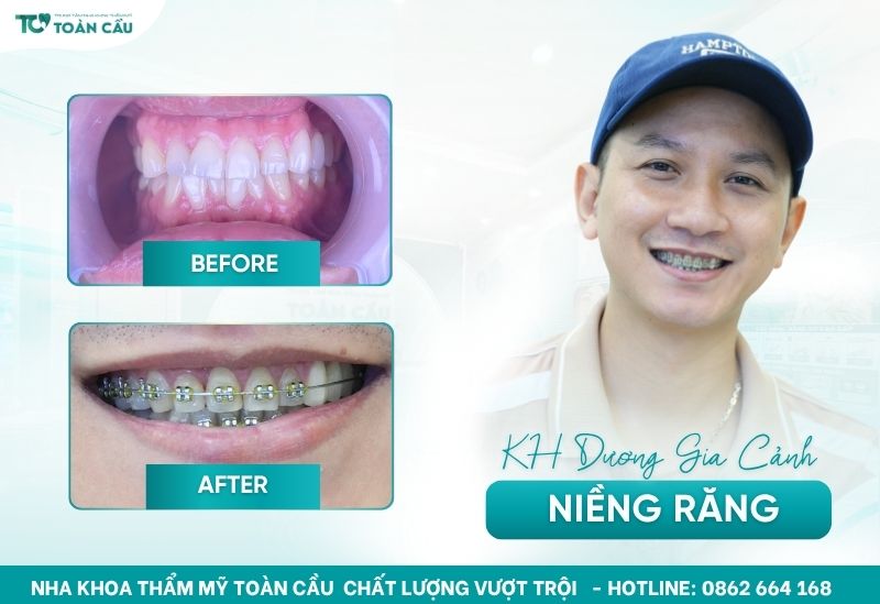 Giải đáp độ tuổi niềng răng tốt nhất là khi nào 6 Khách hàng U30 niềng răng