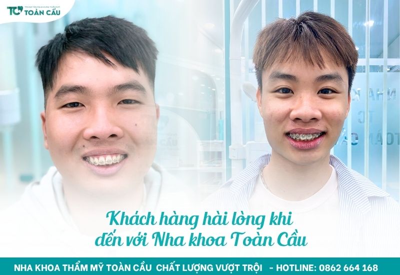 Giải đáp độ tuổi niềng răng tốt nhất là khi nào 8 Niềng răng mắc cài là lựa chọn phổ biến