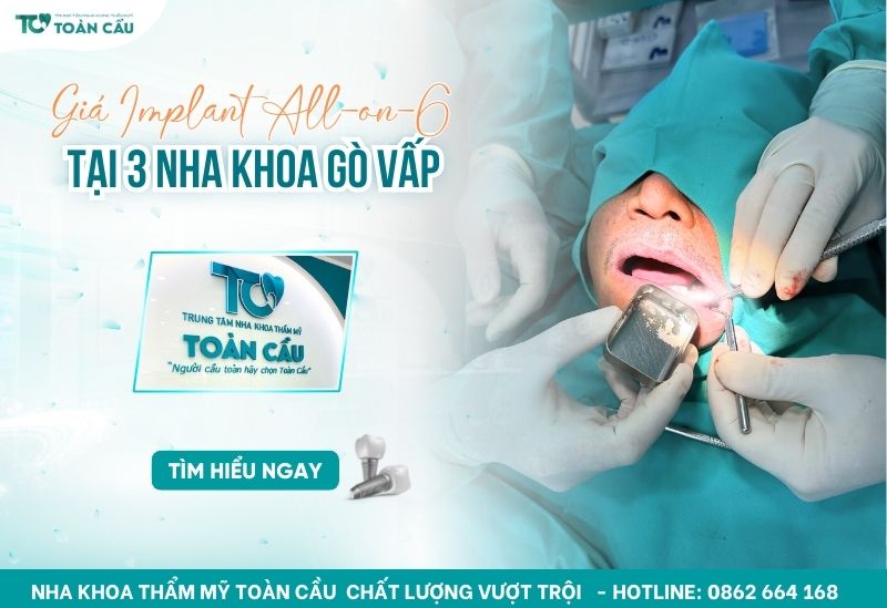 Giá trồng răng toàn hàm All on 6
