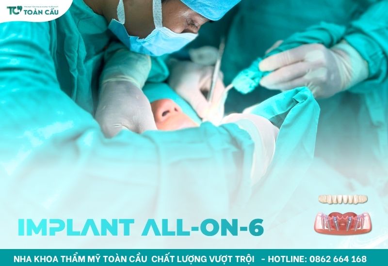 Tham khảo giá trồng răng toàn hàm All on 6 tại 3 nha khoa uy tín Gò Vấp 5 Trồng răng implant toàn hàm All-on-6