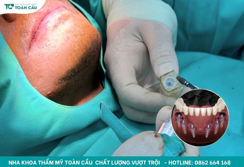 Tham khảo giá trồng răng toàn hàm All on 6 tại 3 nha khoa uy tín Gò Vấp 8 Trồng răng toàn hàm an toàn