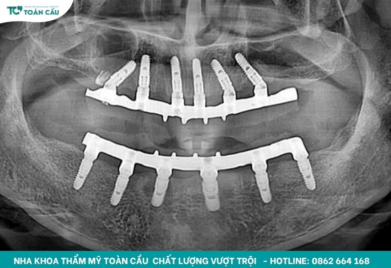 Đâu là giải pháp khắc phục mất răng toàn hàm tối ưu nhất? 5 Kỹ thuật cấy ghép implant nguyên hàm