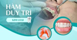 Hàm duy trì kim loại