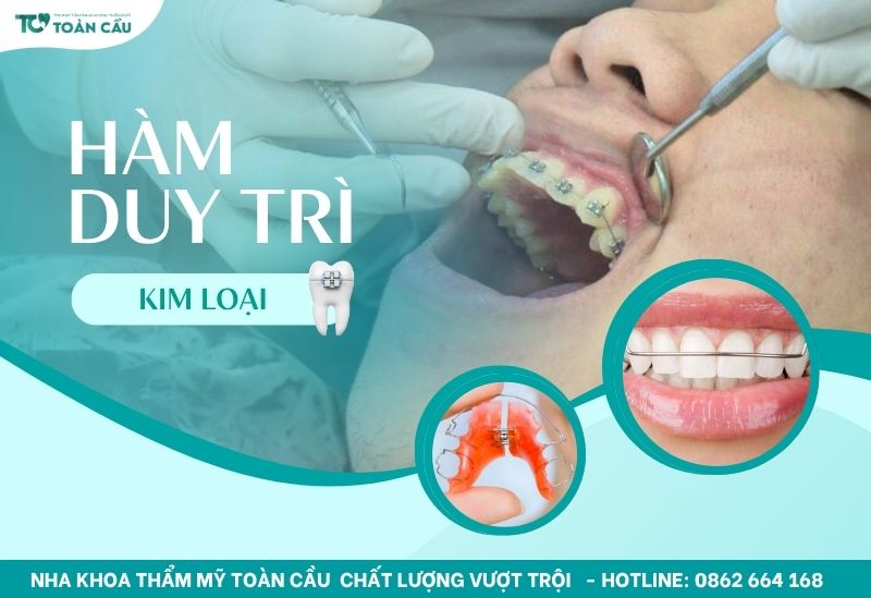 Hàm duy trì kim loại