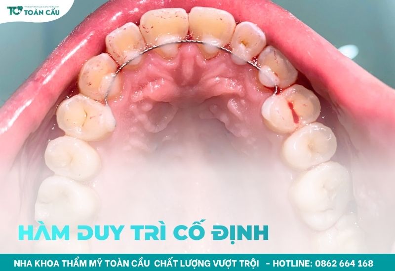Hàm duy trì kim loại có khác biệt gì so với các loại khác? 5 Hàm duy trì kim loại cố định mặt trong