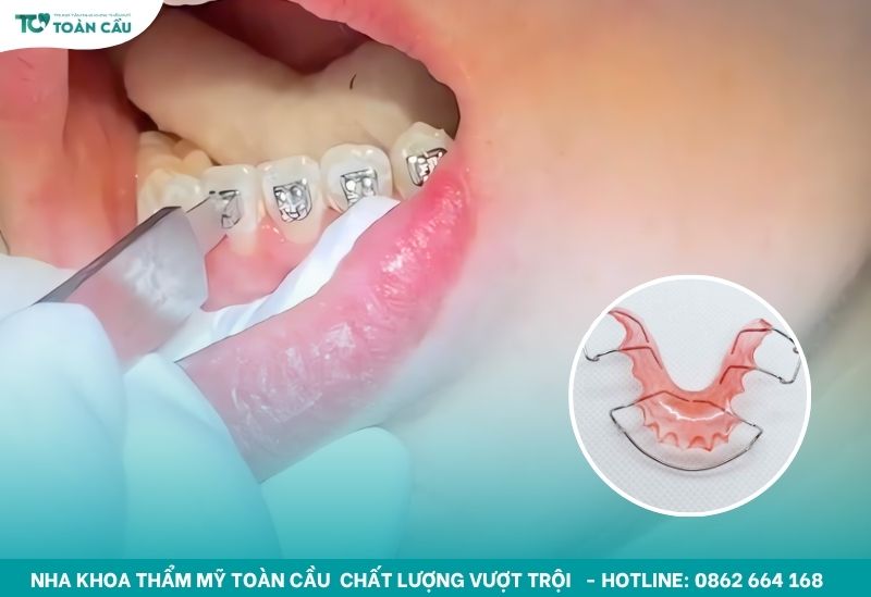 Hàm duy trì kim loại có khác biệt gì so với các loại khác? 6 Hàm duy trì kim loại