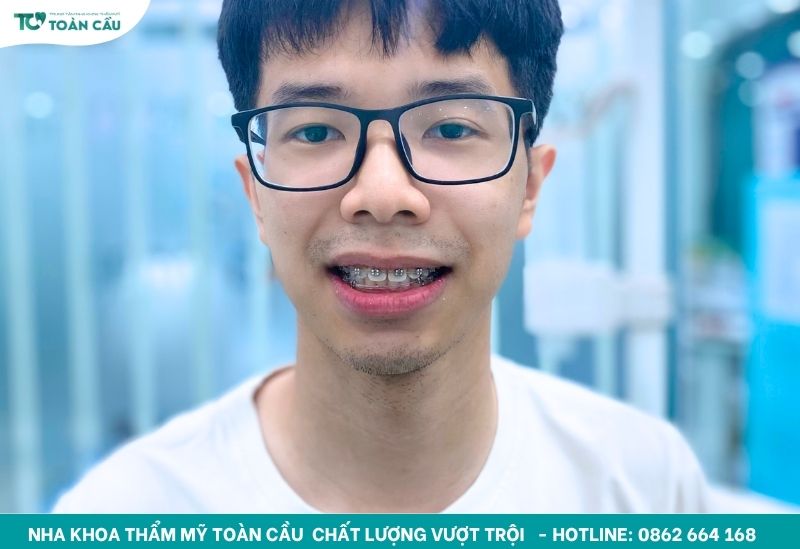 Hàm duy trì kim loại có khác biệt gì so với các loại khác? 8 Hơn 95% người niềng răng phải đeo hàm duy trì