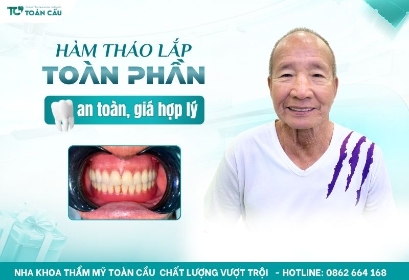 hàm tháo lắp toàn phần