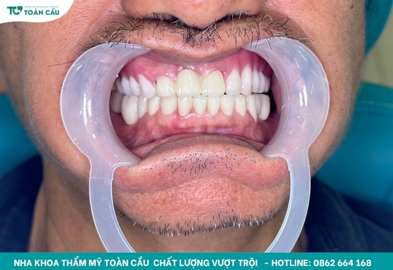 Giải pháp phục hình tiết kiệm cho người lớn tuổi