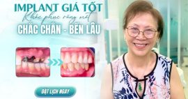 implant không cần ghép xương