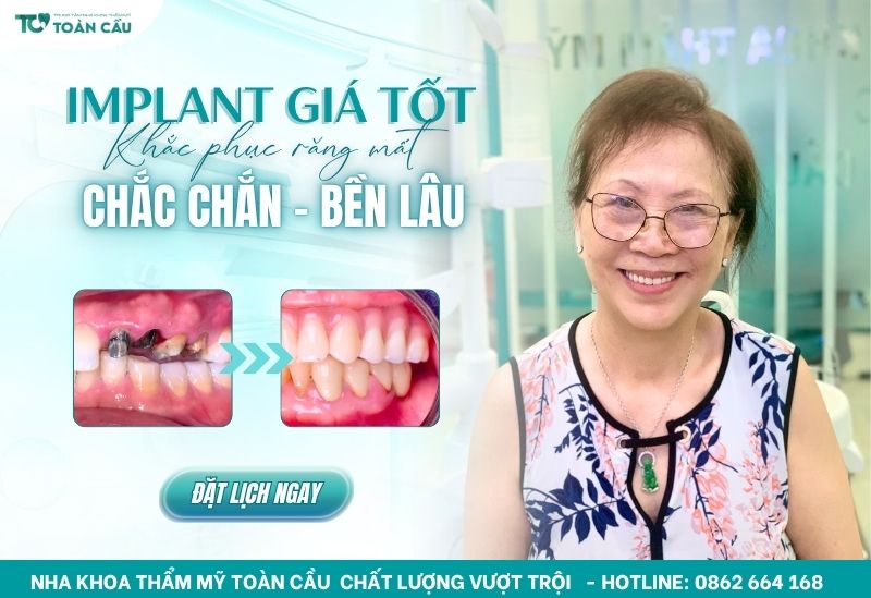 implant không cần ghép xương