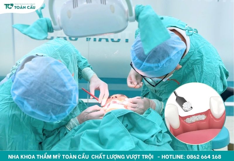 Cấy ghép implant không cần ghép xương tại nha khoa uy tín 7 Ghép xương an toàn để cấy ghép implant