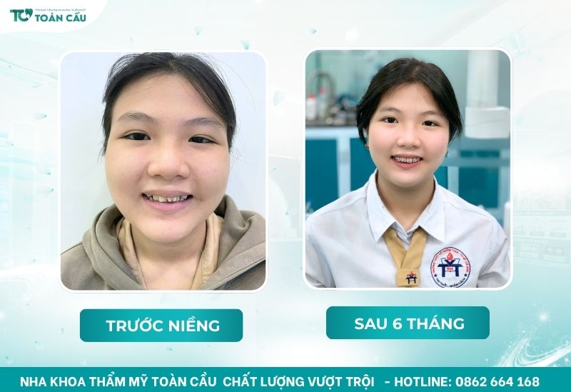 Khách hàng niềng răng tại Nha khoa Thẩm mỹ Toàn Cầu