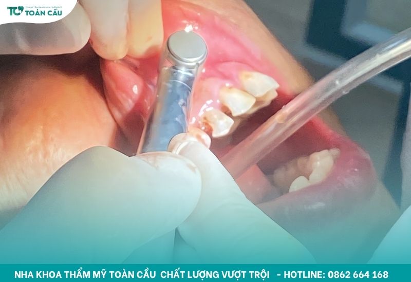 Top 5 nha khoa trồng răng implant toàn hàm trả góp Gò Vấp 6 Cấy ghép implant là kỹ thuật phức tạp