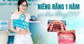 Niềng răng 1 hàm được không