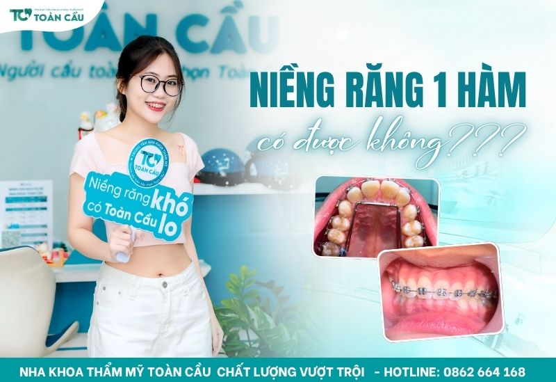Niềng răng 1 hàm được không