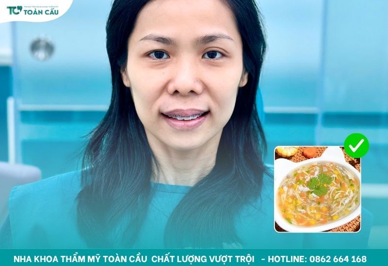 Niềng răng ăn gì và kiêng gì trong tuần đầu tiên? 6 Súp rau củ là món ăn hợp lý