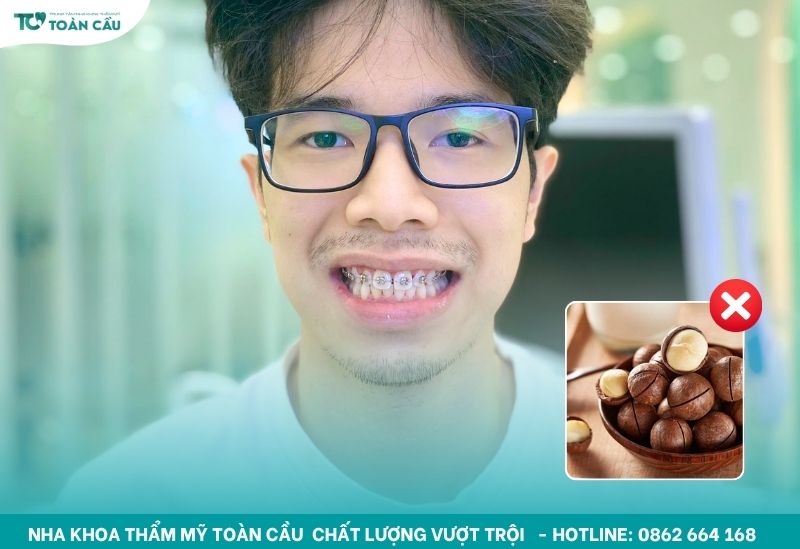 Niềng răng ăn gì và kiêng gì trong tuần đầu tiên? 7 Tránh ăn hạt cứng