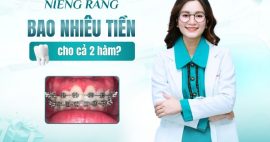 niềng răng bao nhiêu tiền 2 hàm