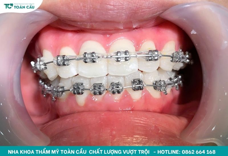 Trung bình niềng răng bao nhiêu tiền 2 hàm tại TPHCM? 5 Cần phải niềng cân đối giữa 2 hàm