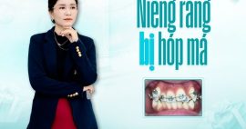 Niềng răng bị hóp má