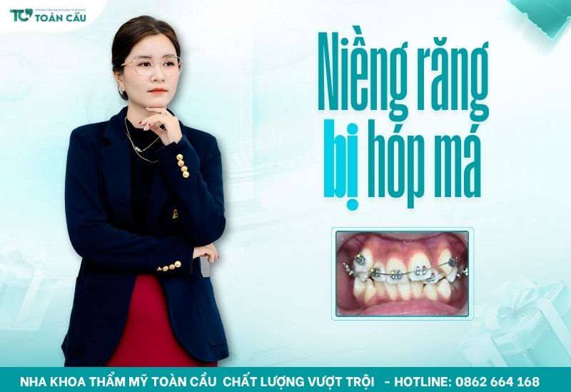 Niềng răng bị hóp má