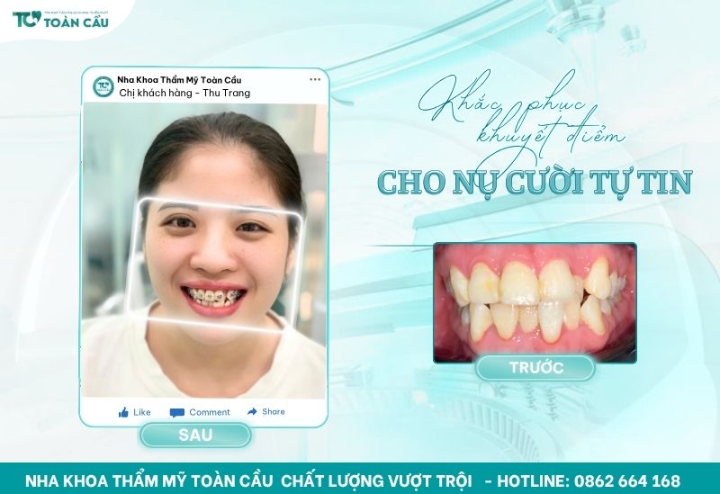 Lý do niềng răng bị hóp má và cách khắc phục cụ thể 5 Niềng răng giúp răng đều, chuẩn khớp cắn
