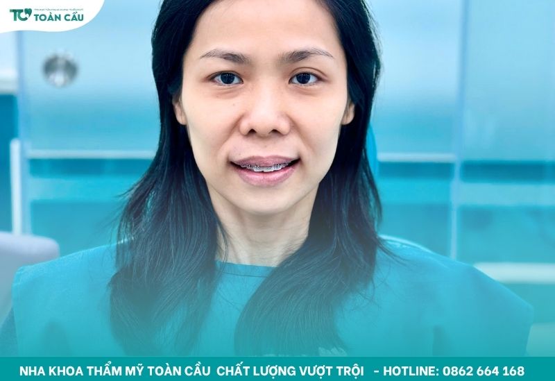 Lý do niềng răng bị hóp má và cách khắc phục cụ thể 6 Tình trạng niềng răng bị hóp má
