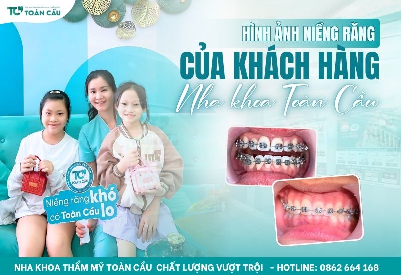 niềng răng đẹp