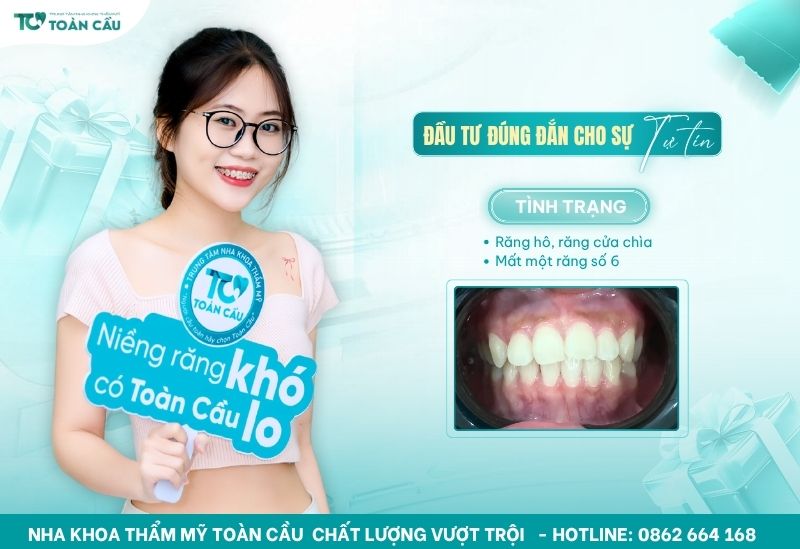 Hình ảnh niềng răng đẹp của khách hàng tại Nha khoa Toàn Cầu 6 Bạn Tiên niềng răng hô chìa