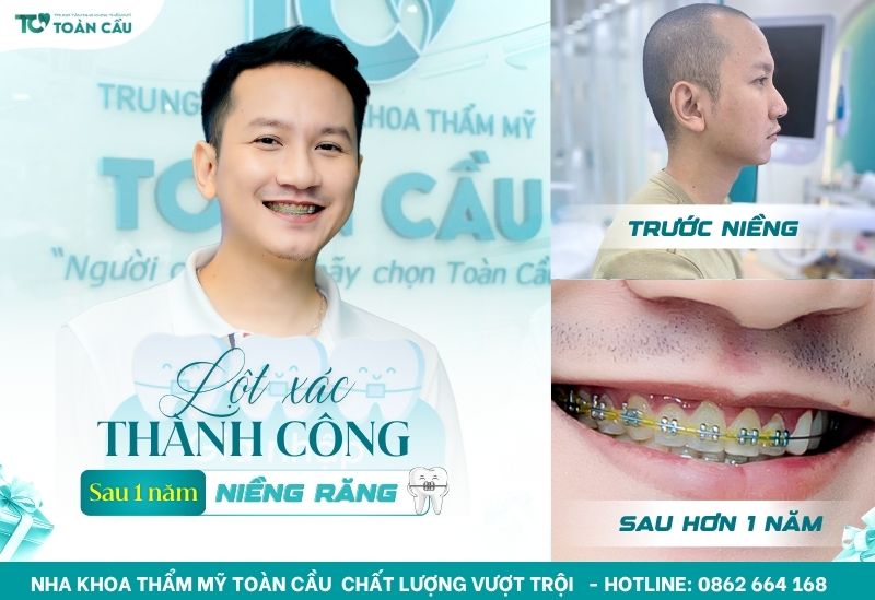 Hình ảnh niềng răng đẹp của khách hàng tại Nha khoa Toàn Cầu 8 Khách hàng Gia Cảnh lột xác tuổi 30
