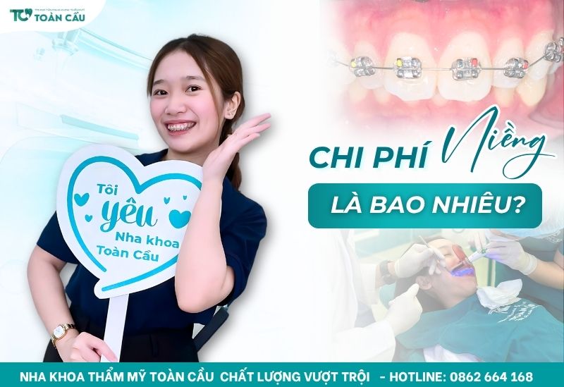 Niềng răng giá bao nhiêu