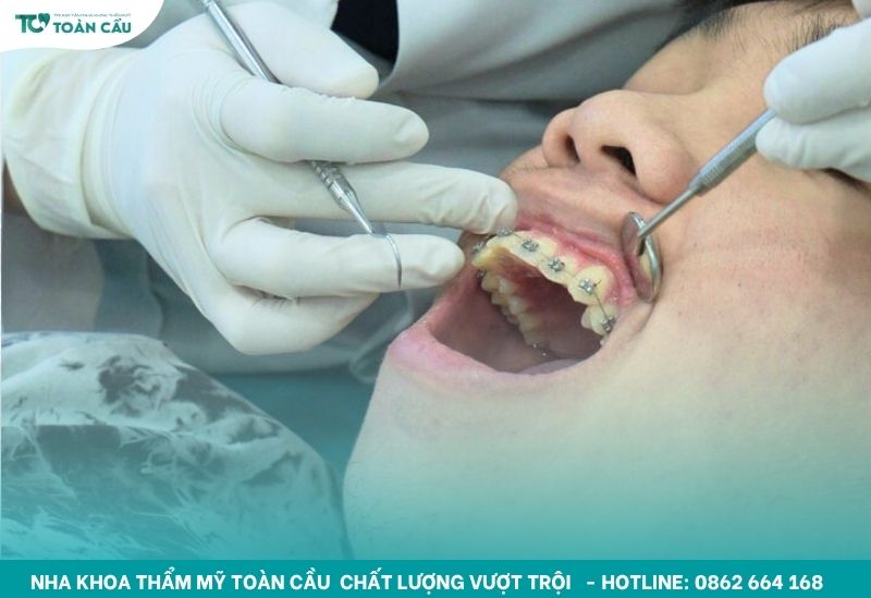 Niềng răng giá bao nhiêu tiền tại nha khoa TPHCM uy tín 7 Niềng răng mắc cài kim loại giá rẻ