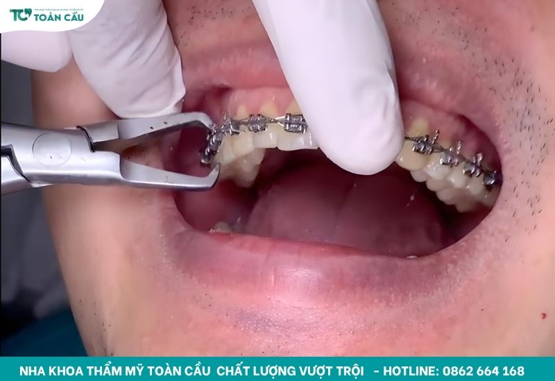 Top 5 địa chỉ niềng răng giá rẻ TPHCM tốt và uy tín 5 Gắn mắc cài kim loại cho khách hàng