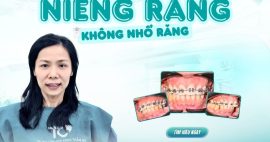 niềng răng không nhổ răng