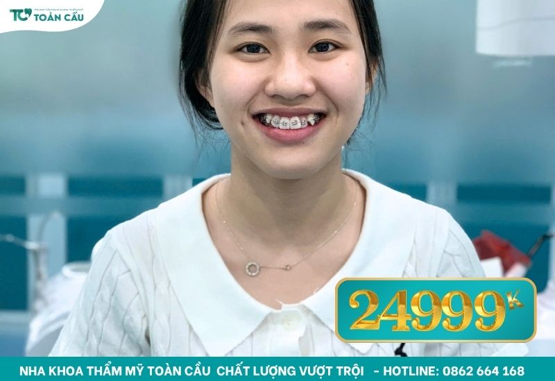 Có thể niềng răng không nhổ răng có được không? 7 Niềng răng chỉ từ 24tr999k