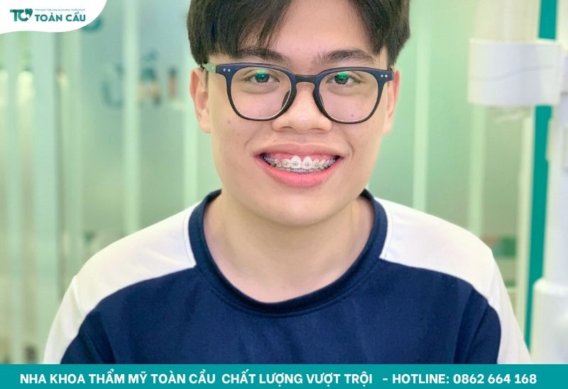 Địa chỉ niềng răng rẻ nhất tại Gò Vấp bạn cần biết 5 Niềng răng giá rẻ cho học sinh - sinh viên