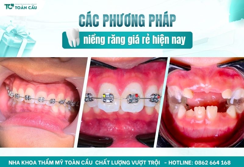 Địa chỉ niềng răng rẻ nhất tại Gò Vấp bạn cần biết 6 Các phương pháp niềng răng giá rẻ hiện nay