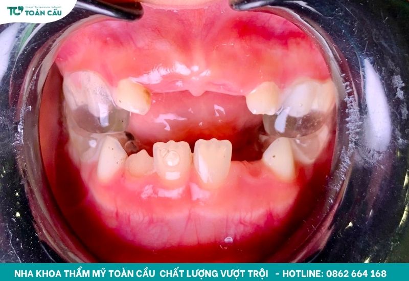 Niềng răng trong suốt có đau không? Giai đoạn nào đau nhất? 7 Đeo khí cụ trong suốt để chỉnh nha