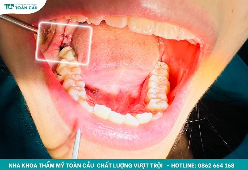 Phòng khám nhổ răng khôn không đau an toàn tại Gò Vấp 5 Răng khôn gây đau nhức