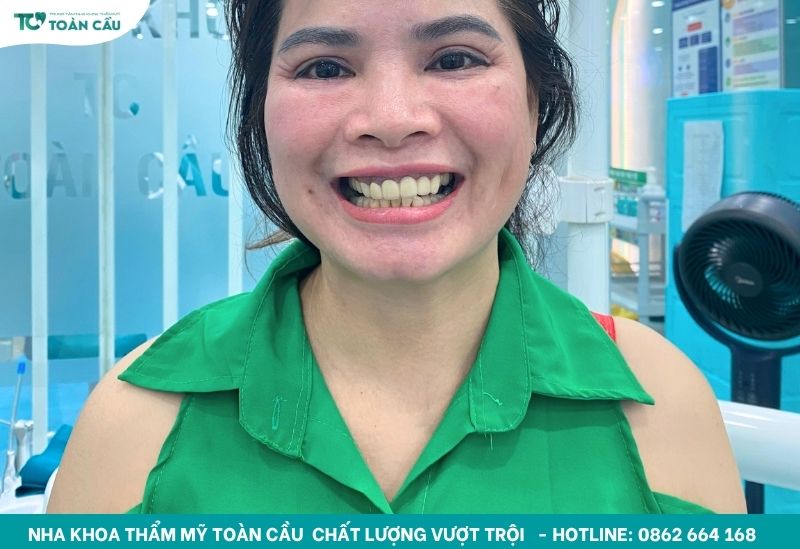 Phục hình trên implant hiệu quả cho người mất răng lâu năm 5 Trồng răng sứ trên trụ implant