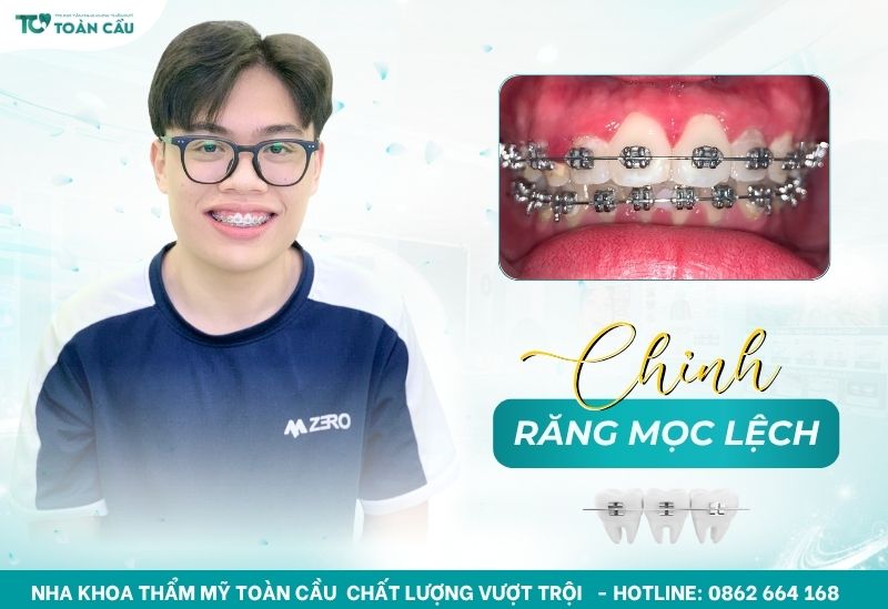 răng mọc lệch